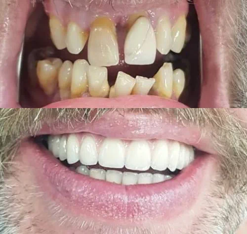 Failing, misshapen, missing teeth before smile in a day treatment at Bristol Almondsbury Dental Implant Clinic by Ioannis Kakisis.